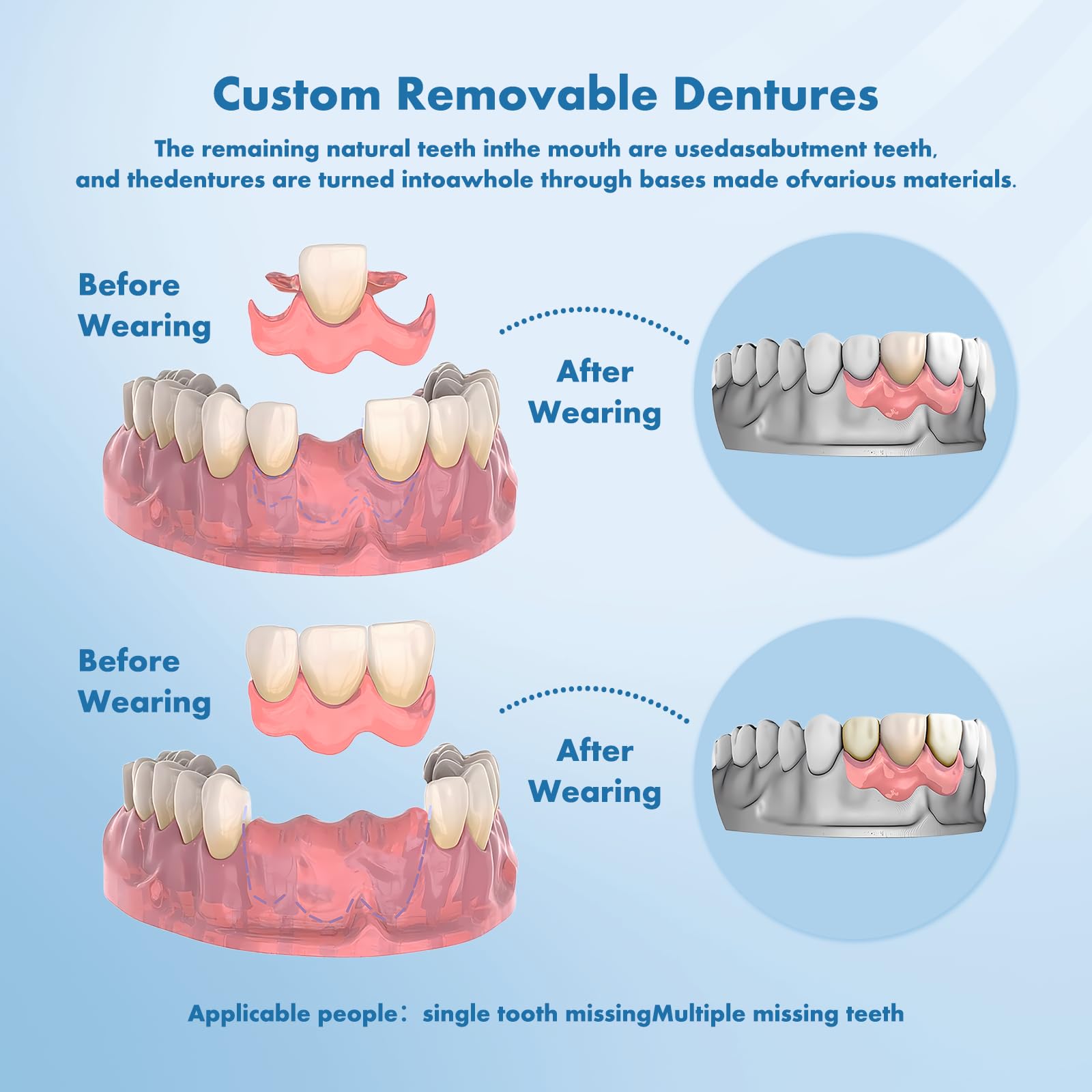 Custom Removable Dentures – Personalized Partial Denture Set with Storage Case | 1–6 Teeth Coverage
