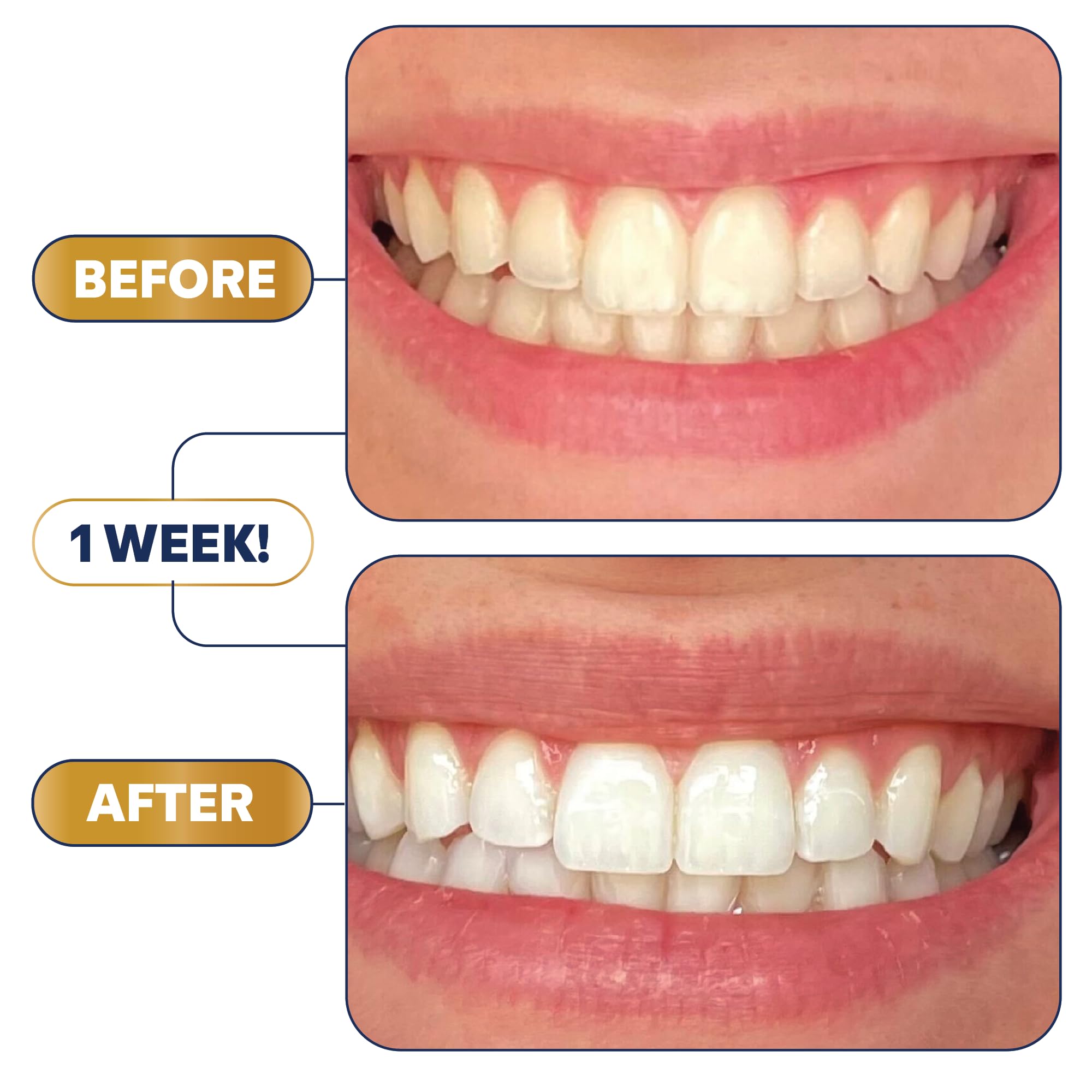 Lumineux Teeth Whitening Strips – 21 Treatments, Peroxide Free, Enamel Safe