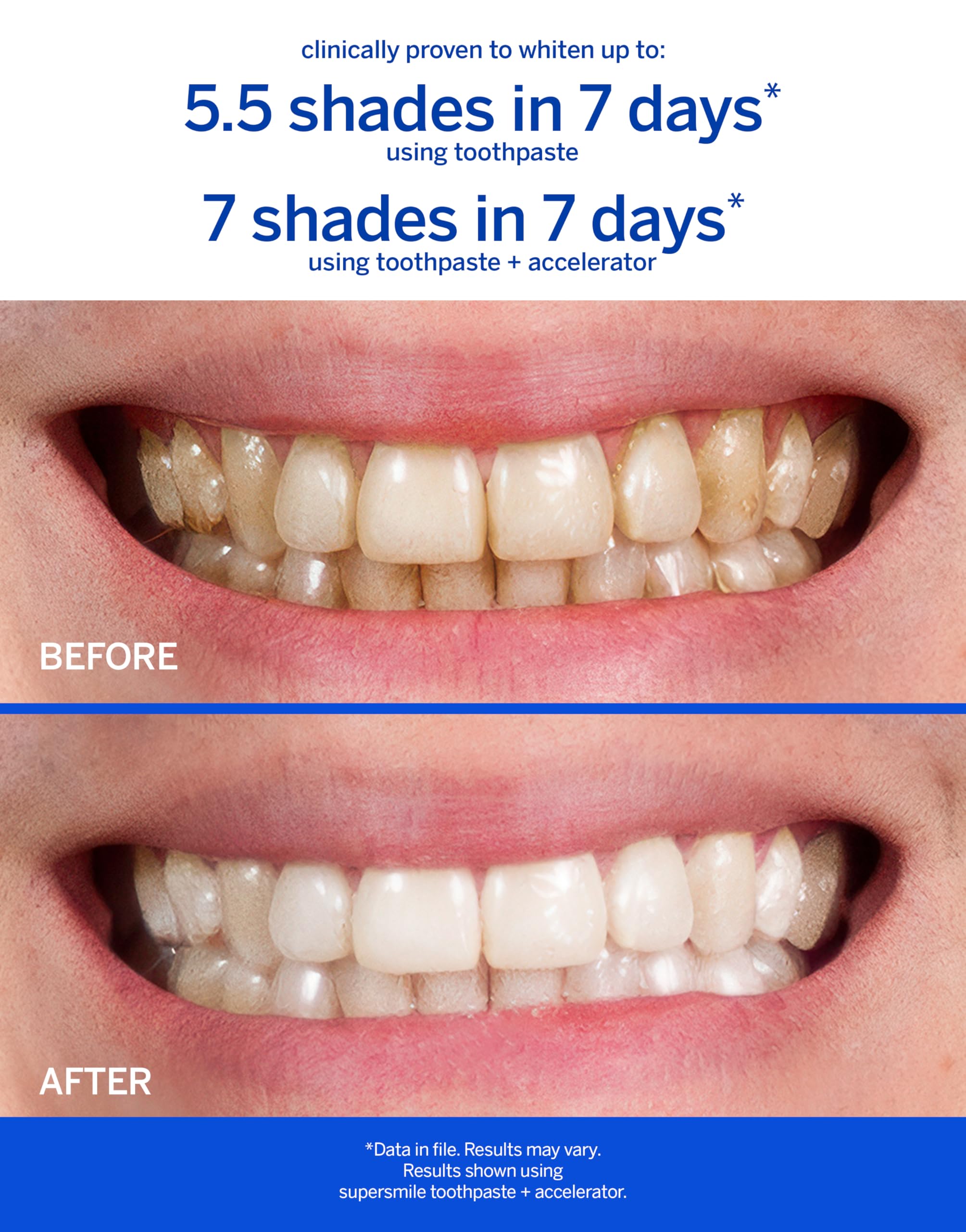 Supersmile Pro Whitening Toothpaste with Fluoride – 6 Shades, Enamel Strength, Travel Size 1.4 oz