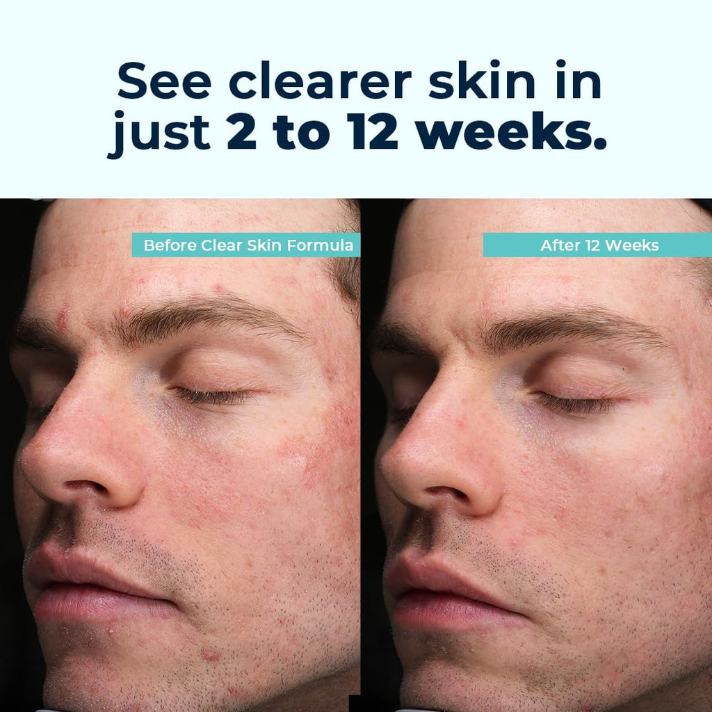 VitaMedica Clear Skin Vitamin Formula | Noncystic Acne Supplement for Clear Complexion | 60 Count